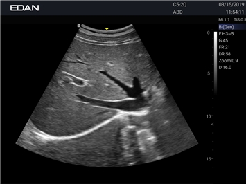 EDAN Acclarix AX3