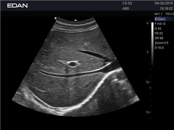 EDAN Acclarix AX3