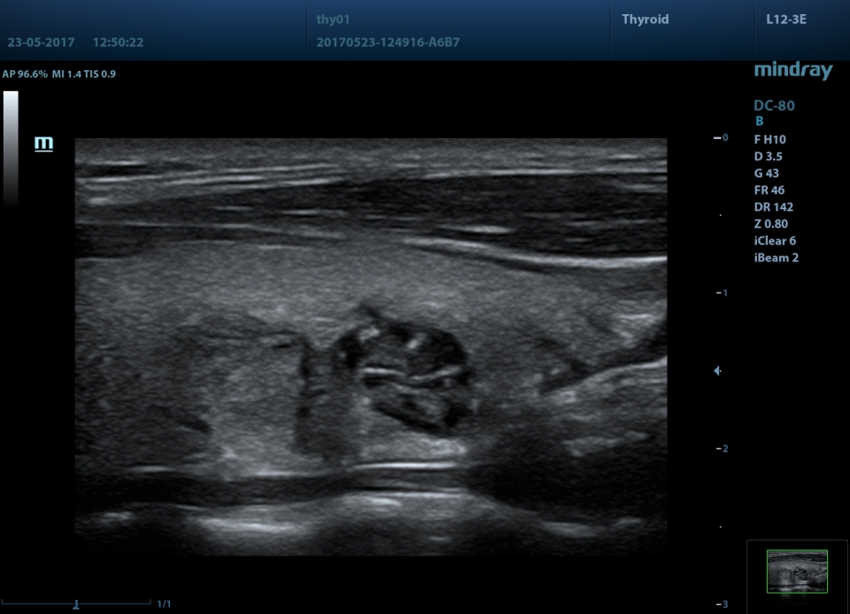 Mindray DC-80 X-Insight