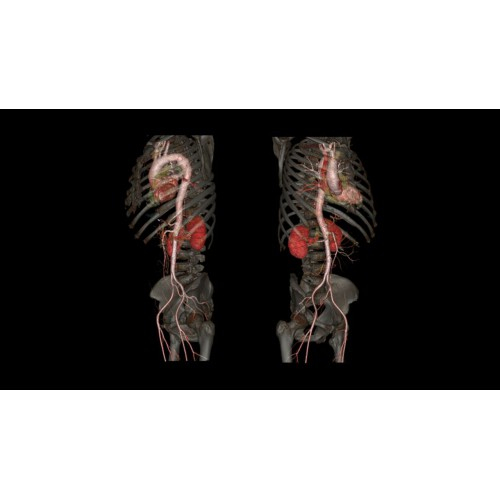 КТ аппарат GE Revolution CT